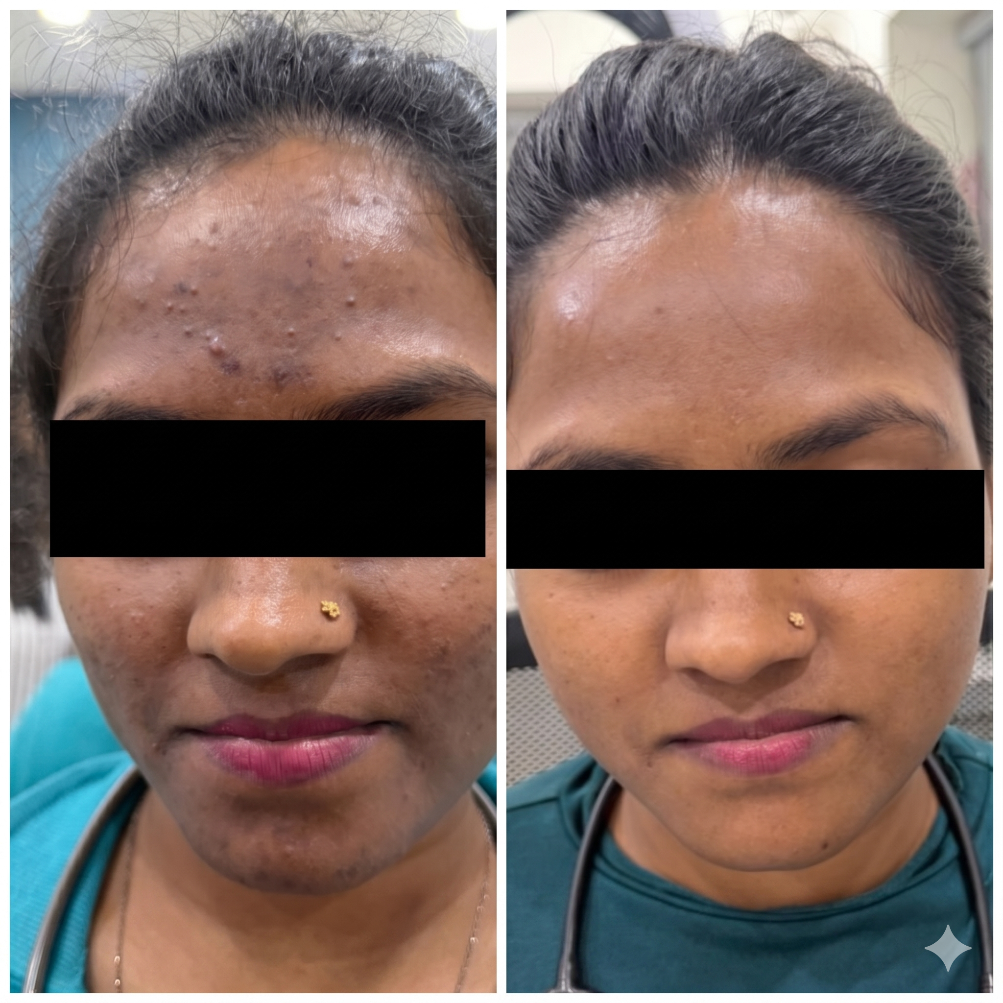 Acne Treatment